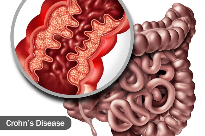 Inflammatory Bowel Diseases