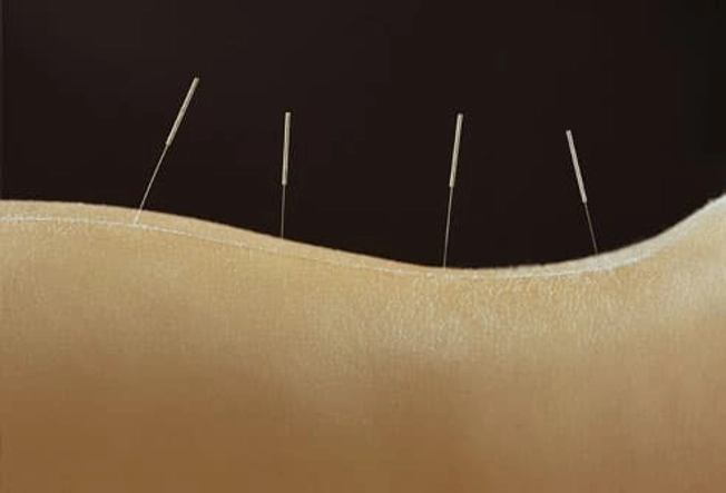 Fact: Acupuncture May Ease Pain