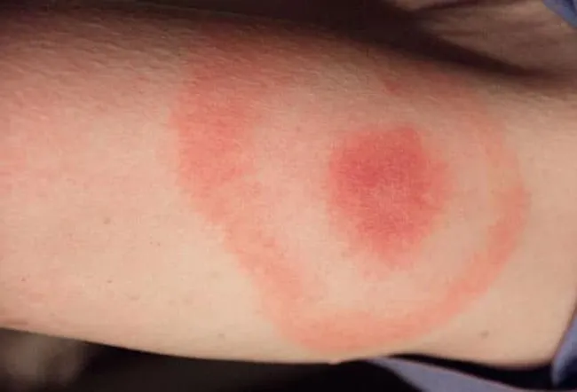 Lyme Disease Symptoms Causes Diagnosis Treatment Prevention Lyme Disease Symptoms Causes Diagnosis Treatment Prevention