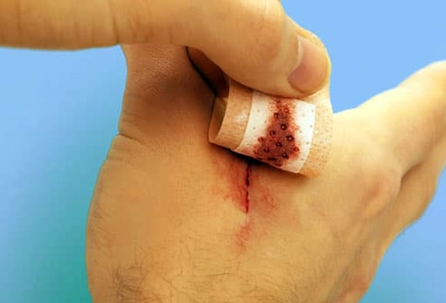 Cuts on Hands or Feet: Keep Them Clean