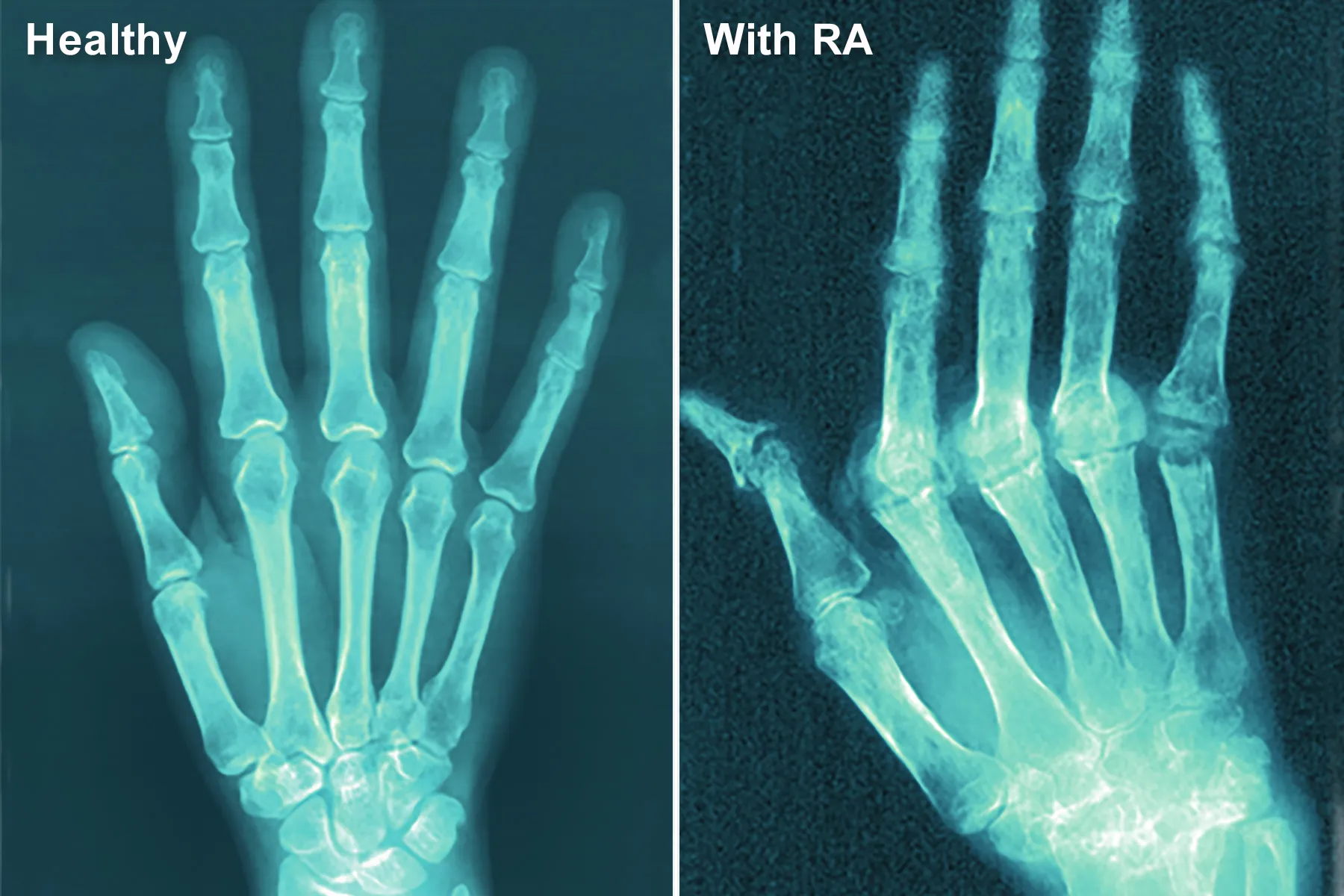 FDA Warns of Hidden Components in Arthritis, Ache Merchandise