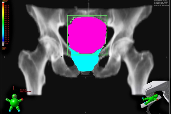 Treatment: Radiation