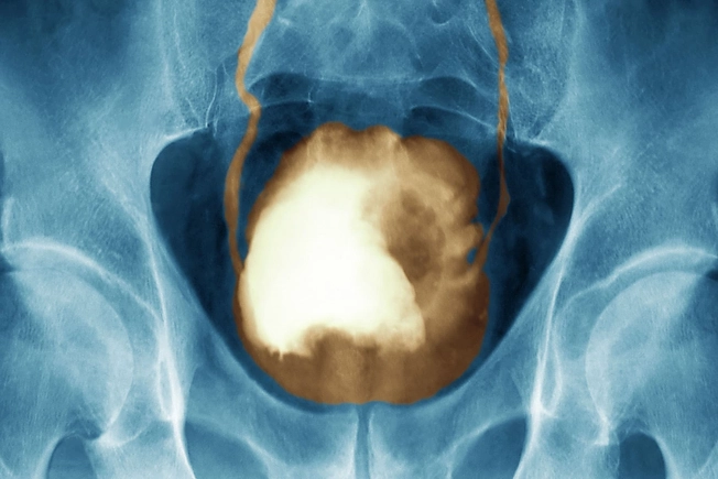 Warning Sign: Bladder Changes