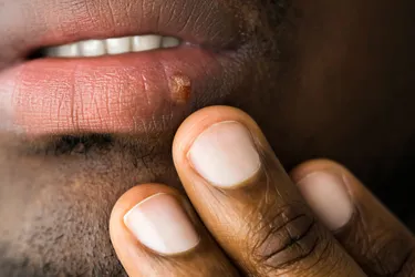 Herpes can cause blisters around your mouth or genitals. These blisters come and go and may be painful. (Photo Credit: iStock/Getty Images) 