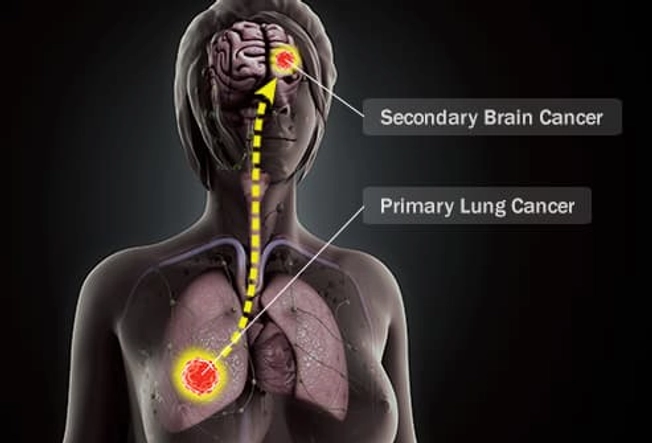 Cancer That Has Spread To The Brain – CIFK
