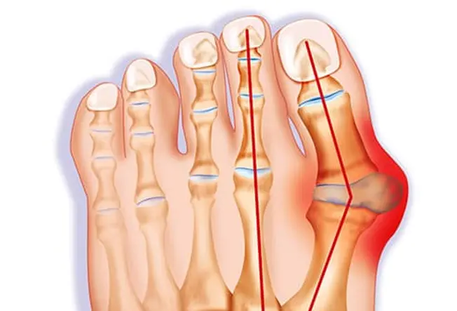 What Is a Bunion?