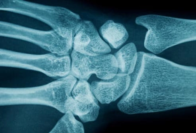 What Causes Carpal Tunnel Syndrome?