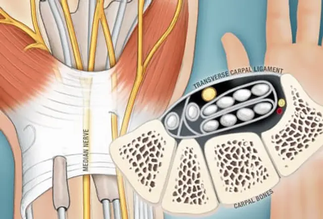 What Is Carpal Tunnel Syndrome?