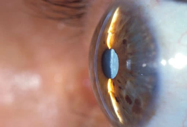 How Are Cataracts Diagnosed?