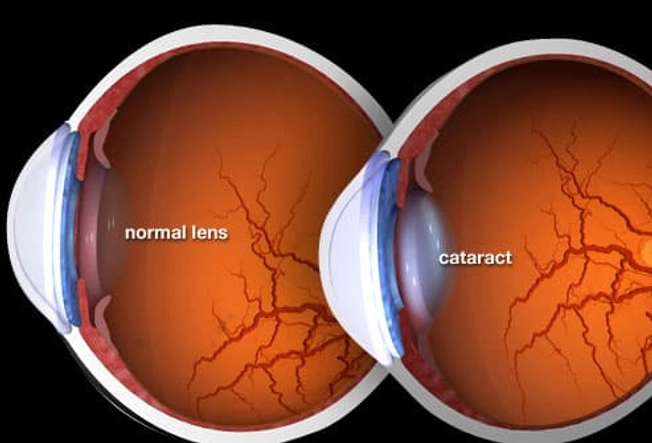 How Cataracts Affect Your Vision