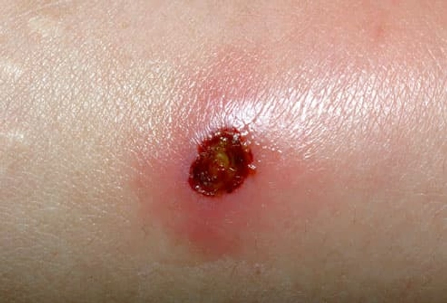 MRSA/Staph Infection