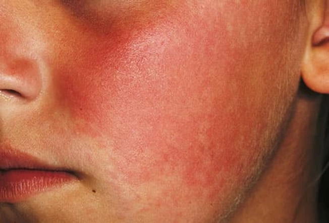 Fifth Disease