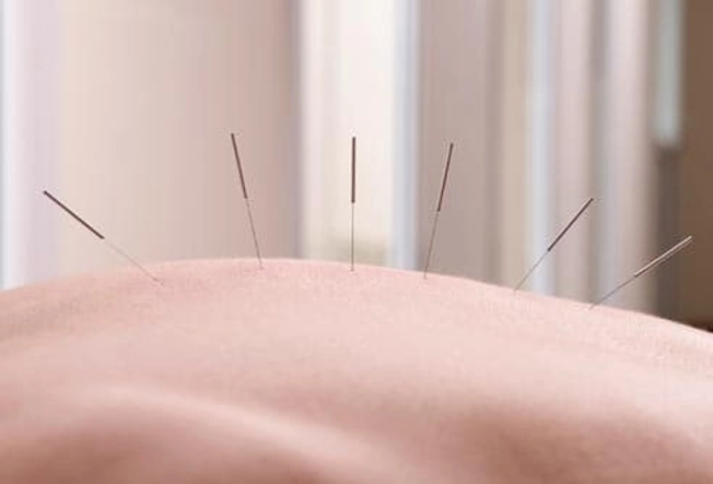 Pain Relief: Acupuncture