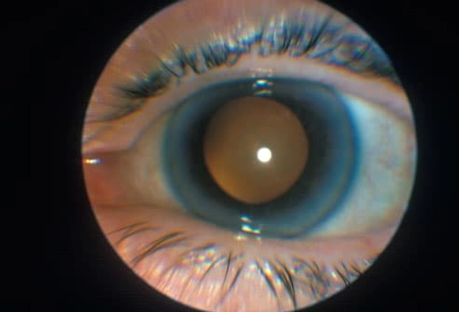 Cataracts: What Happens