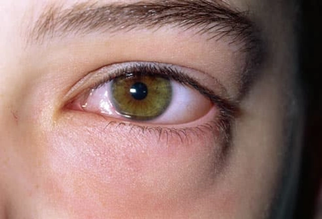 Allergies