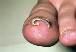 Ingrown nails -- when your nail grows into the flesh instead of over it -- usually affect your toenails, especially your big toe. (Photo credit: Science Source)