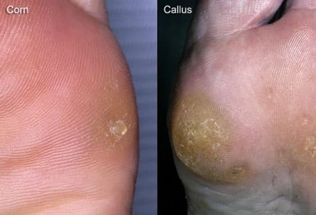 Corns and Calluses