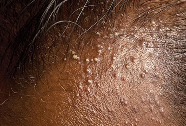 Folliculitis