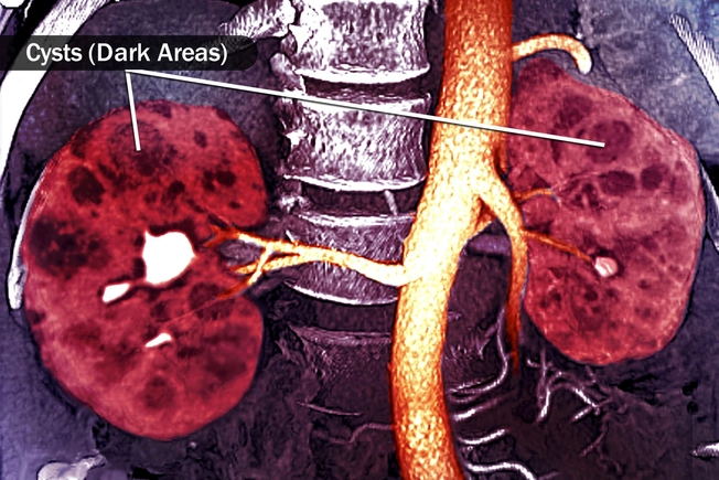 Polycystic Kidney Disease (PKD)