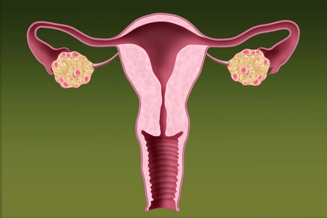 Polycystic Ovarian Syndrome (PCOS)