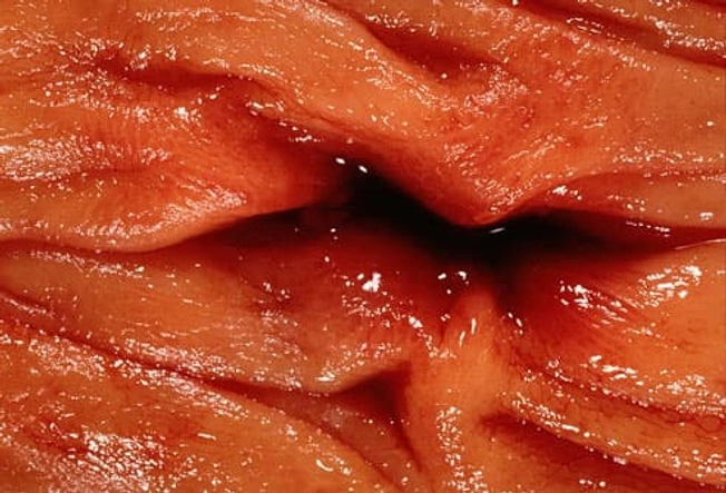 Complications of Diverticulitis Complications of Diverticulitis