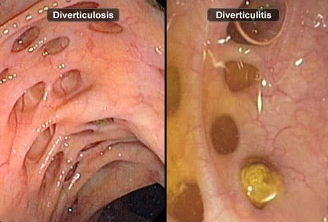 Diverticulosis vs. Diverticulitis Diverticulosis vs. Diverticulitis