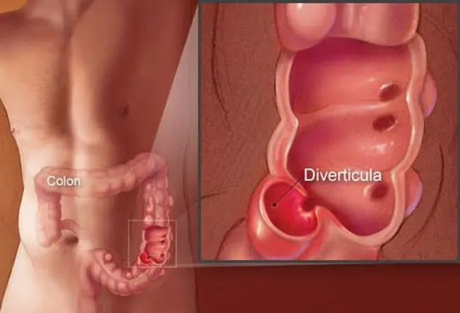 What Is Diverticulitis? What Is Diverticulitis?