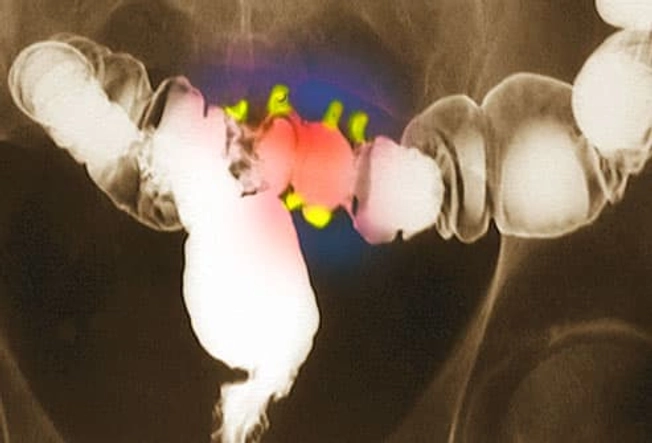Diagnosing Diverticular Disease Diagnosing Diverticular Disease