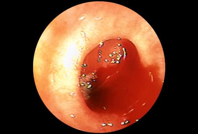 Diverticular Bleeding Diverticular Bleeding