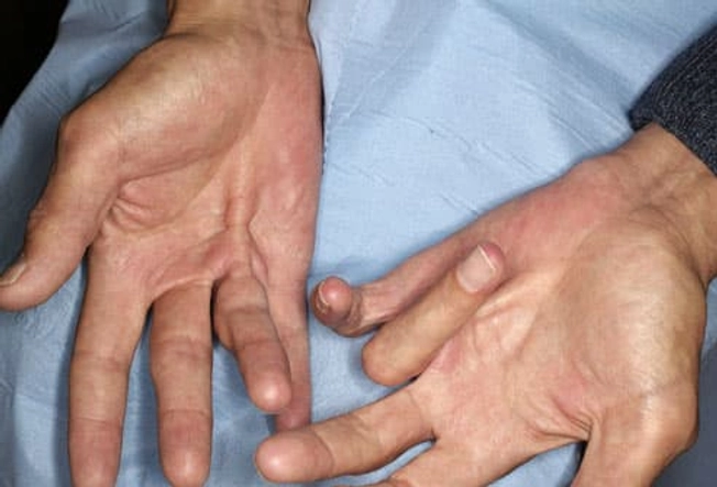 Later Symptoms of Dupuytren's Contracture