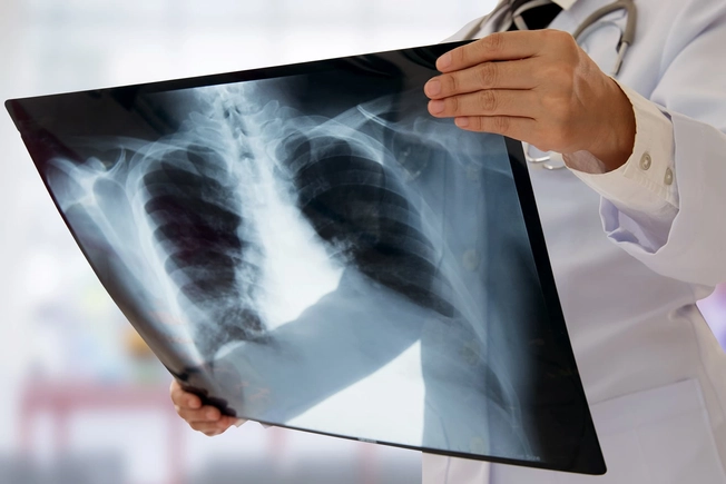 10 Years: Lung Cancer 10 Years: Lung Cancer