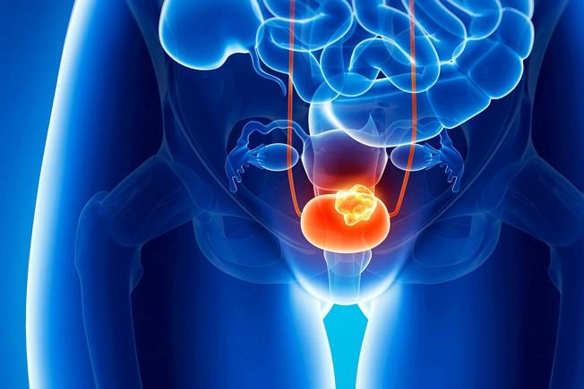 Lowering Bladder Cancer Risk