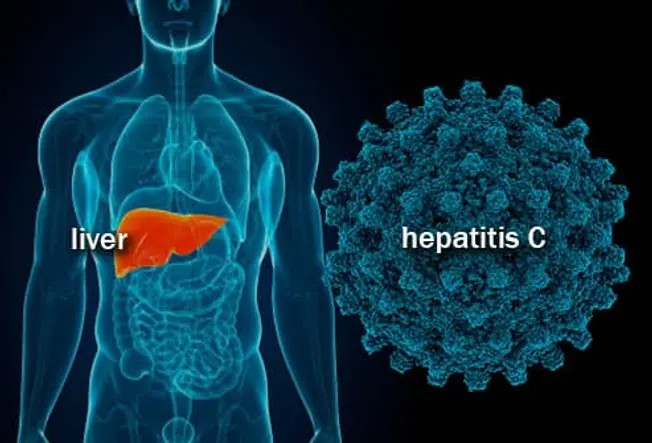 Hepatitis C: What Is It?