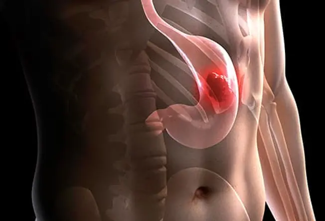 What Is Gastric Cancer?