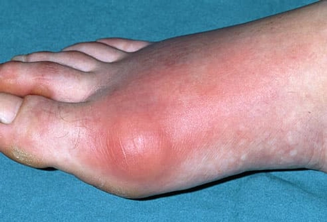What Gout Looks Like: The Big Toe