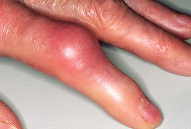 What Gout Looks Like: The Fingers