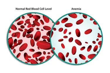This demonstrates the difference between a normal red blood cell level and the red blood cell level of someone with anemia.  Photo credit: iStock / Getty Images 