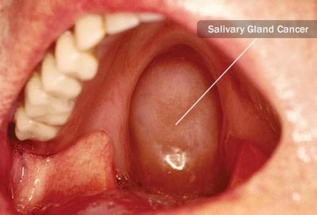 Type: Salivary Gland Cancer