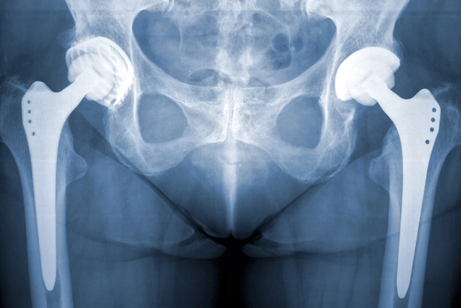 Both Hips at Once?