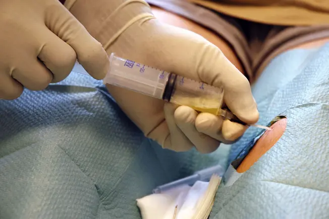 What Is a Spinal Tap?