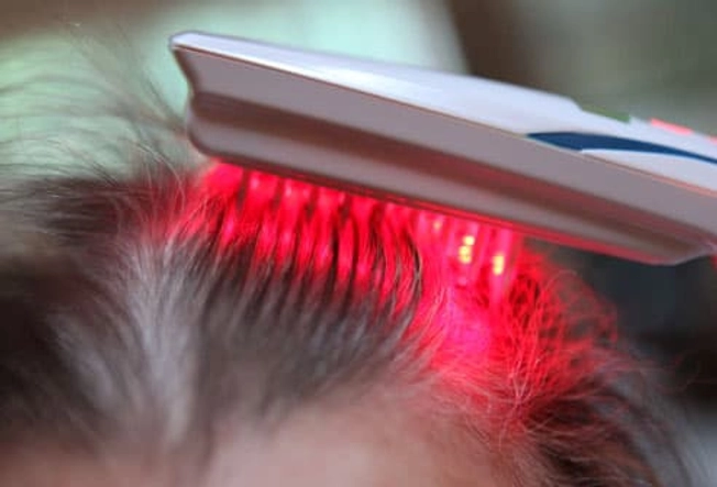 Treating Hair Loss: Lasers