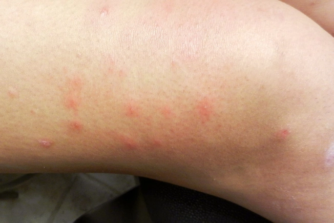 Bug Bites or Stings