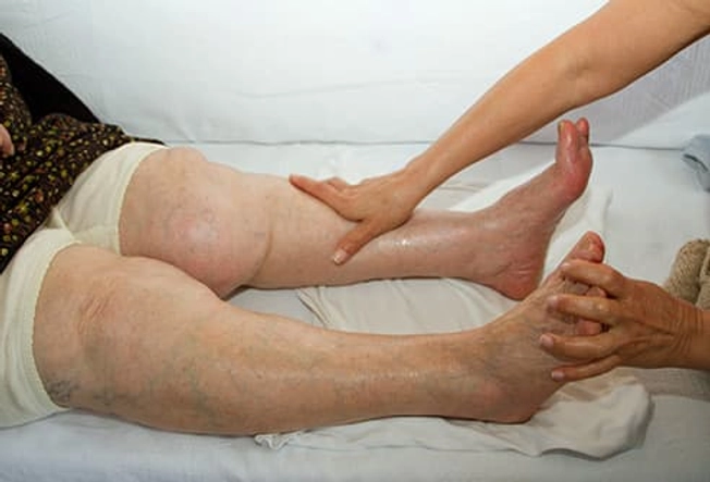 Swelling In Lower Legs