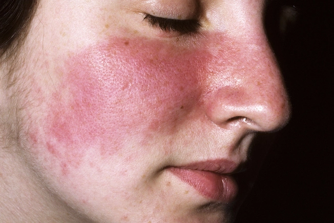 Photodermatitis