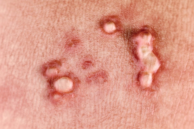 Genital Warts