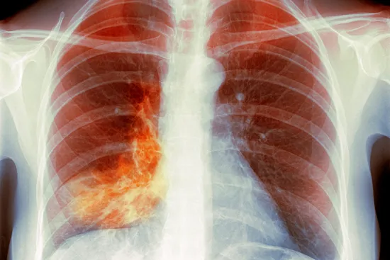 photo of x-ray revealing pneumonia in lung