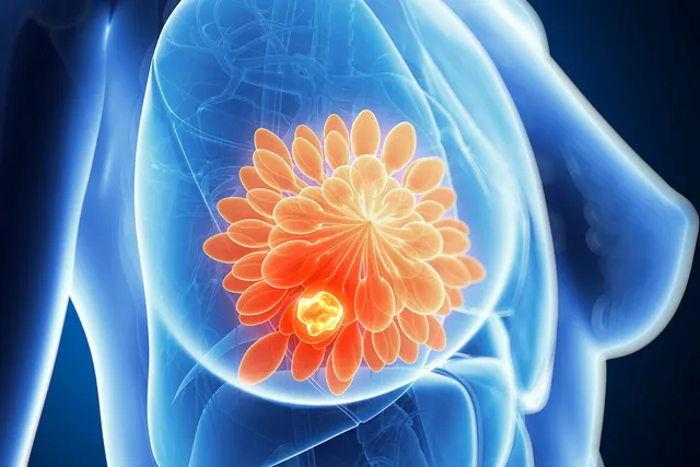 What Are the Stages of Breast Cancer?