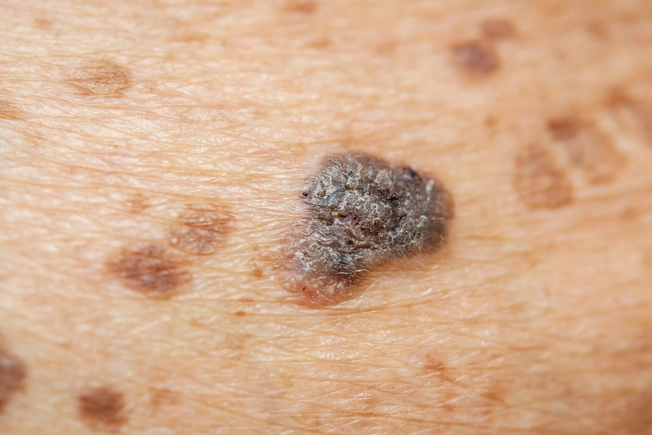 Skin Cancer