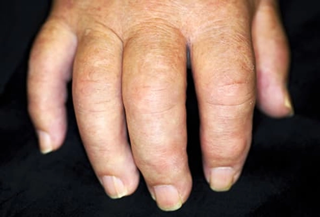 Swollen Fingers and Toes