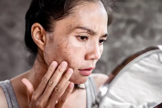 Treating Age Spots